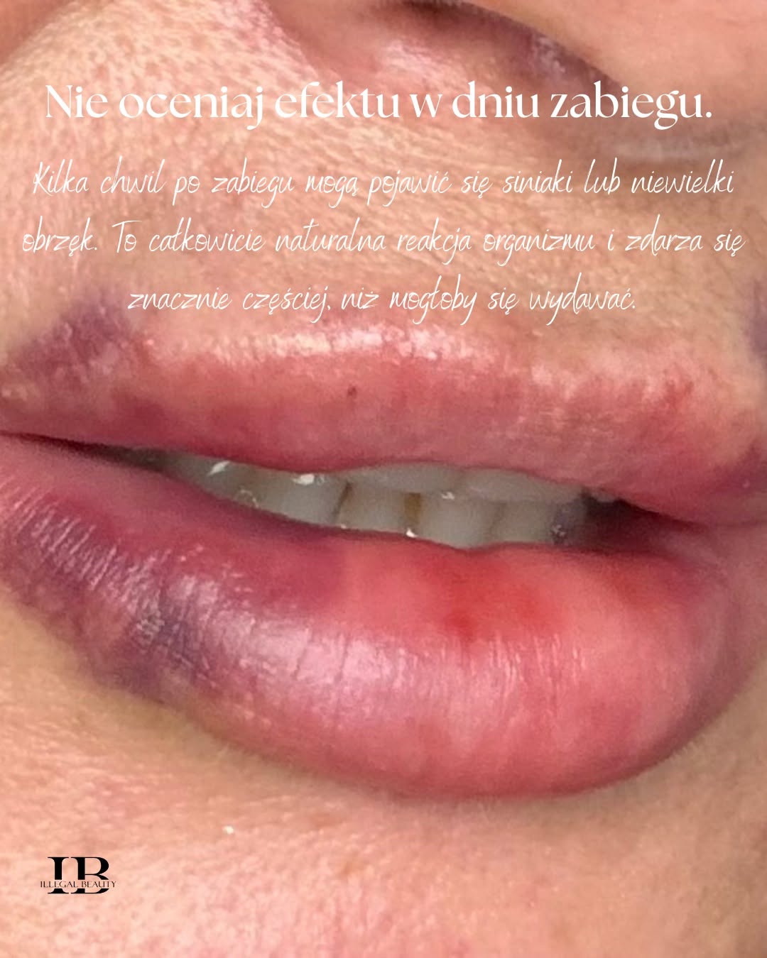 Tak też może wyglądać modelowanie ust. 👄